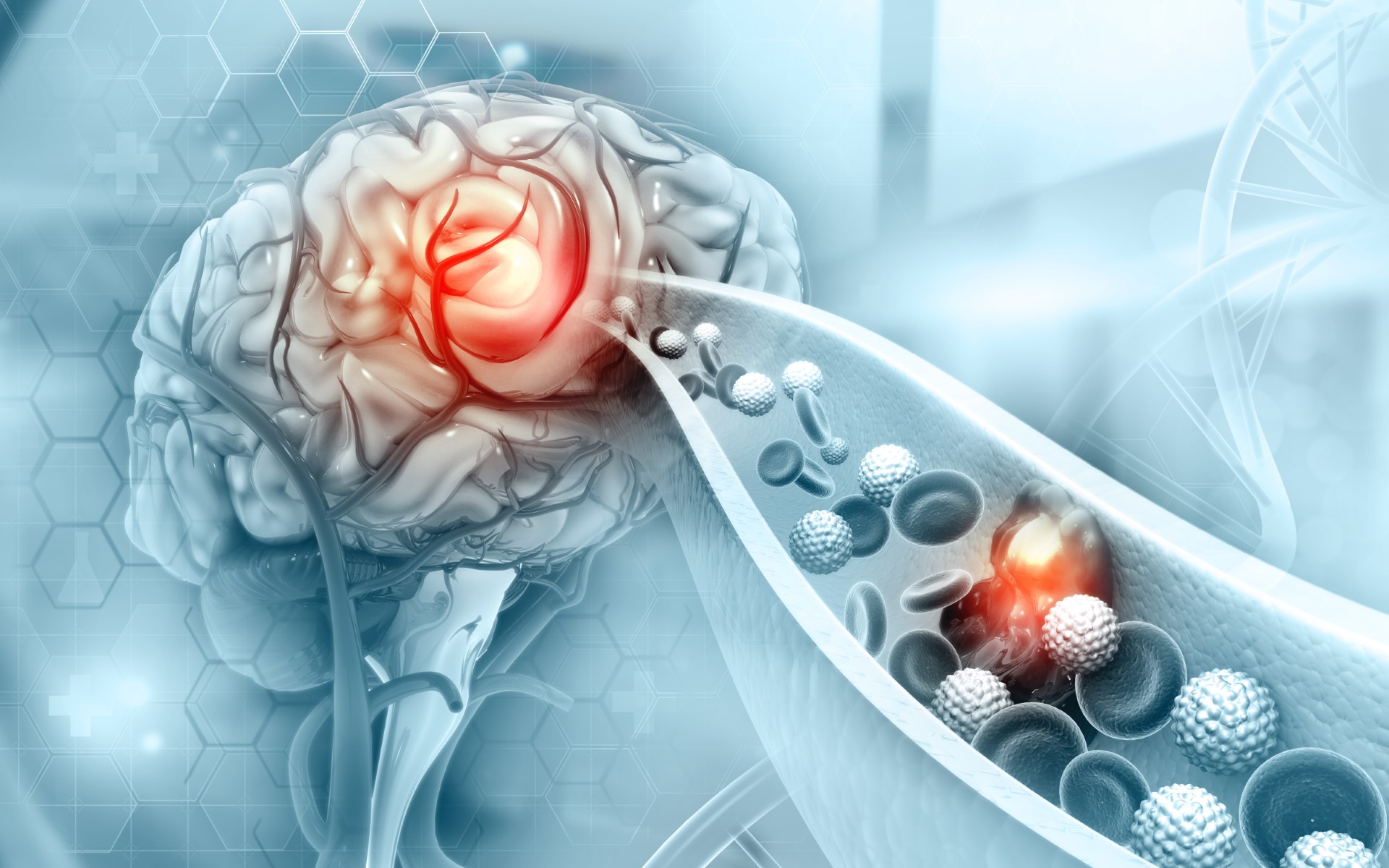 Vestibular migraine: Progress in the search for treatments - Harvard Health